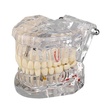 1 ШТ Прозрачная Модель Патологических Зубов С Мостовидным Протезом, Прозрачный Пластик Для Обучения Пациентов И Студентов